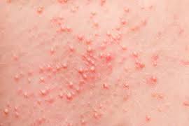 Skin Disease